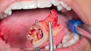 Remove the rotten wisdom tooth