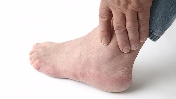 How to Recognize Gout Symptoms | Foot Care - DayDayNews