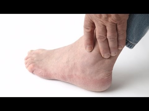 How To Recognize Gout Symptoms | Foot Care