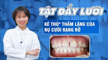 Tật đẩy lưỡi - "Kẻ thù" thầm lặng của nụ cười rạng rỡ | Nam Bùi Vinalign