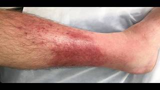Cellulitis; bacterial infection of the skin and subcutaneous tissues
