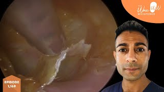 1,169 - Tinnitus Resolved Post Ear Wax Removal & Dead Skin Peel