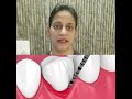 पायरिया के लक्षण | Symptoms of pyorrohea/ periodontitis | Dental facts #shorts