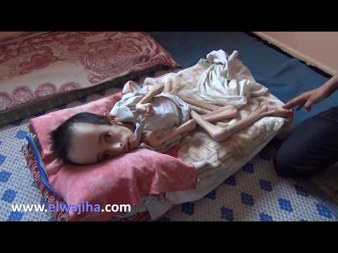 أغرب انسان في العالم.. لا يسمع.. لا يرى.. ولا يأكل..