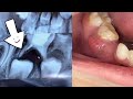 Baby tooth abscess and extraction