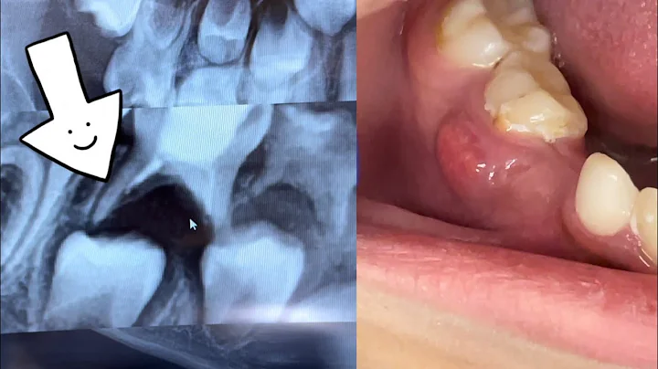 Baby tooth Abscess and extraction - DayDayNews