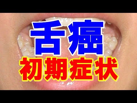 【驚愕】舌癌の見逃しがちな前兆とは！可能性がある驚きの症状・・・【豆知識】