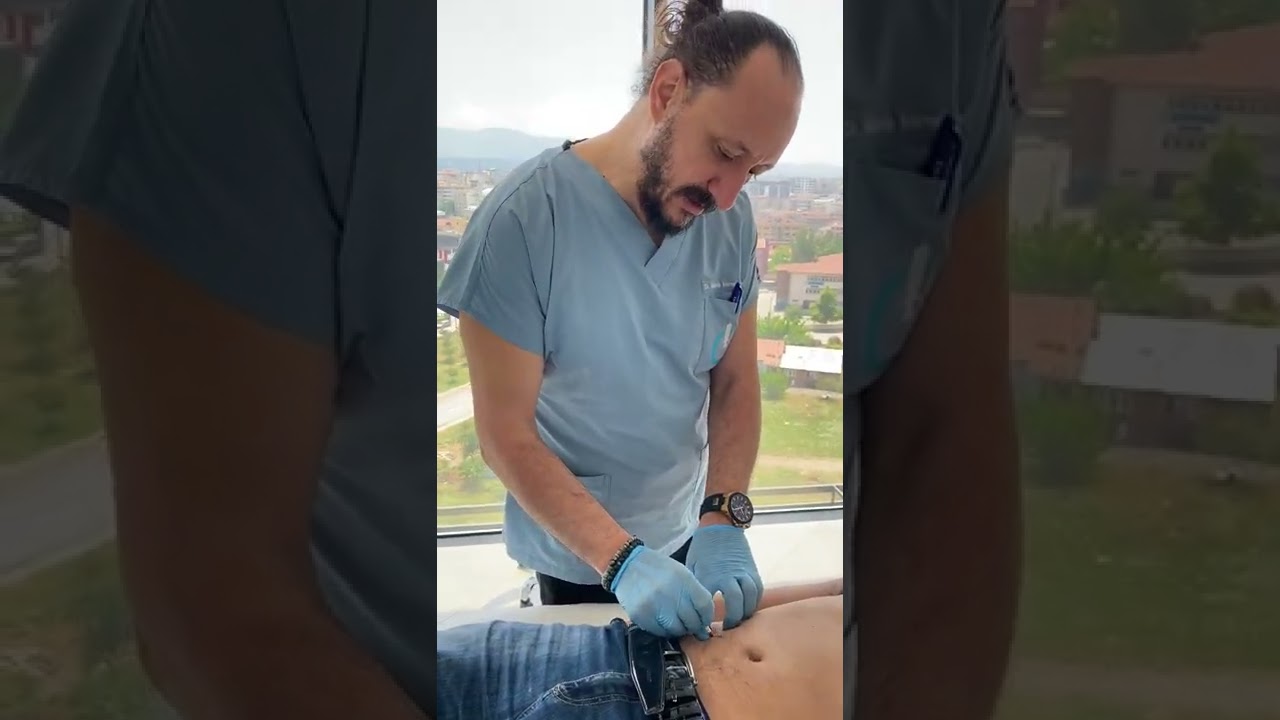 Karın Ağrısı, Anterior Cutaneus Nerve Entrapment Syndrome (ACNES)