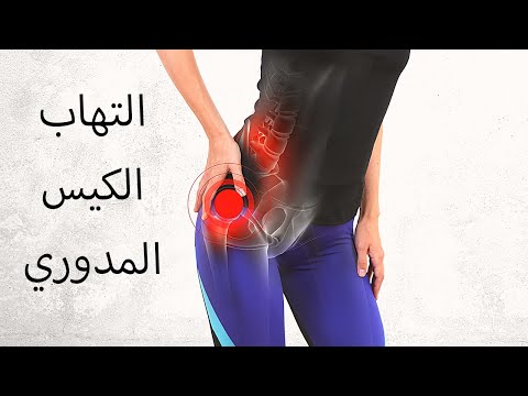 التهاب الكيس (الجراب) المدوري - Trochanteric Bursitis