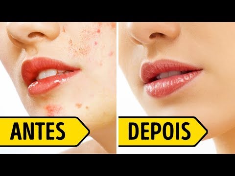 Tratamento Pós-Acne para Se Livrar das Cicatrizes em 3 Dias