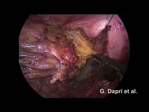 Up-to-Down Rectal Resection With Total Mesorectal Excision Through Single-incision Laparoscopy