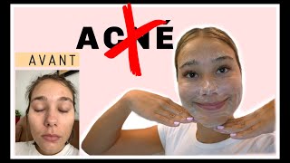 j'essaie une nouvelle routine pour mon acné!