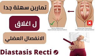 تمارين اغلاق الانفصال العضلي بلبيت | Diasstasis recti تمارين المراة diastasisrecti