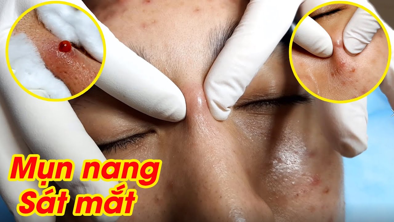 Mụn nang khổng ngay sát mắt | HHV Clinic | Đỗ Thu Hiền | Hiền Vân Spa