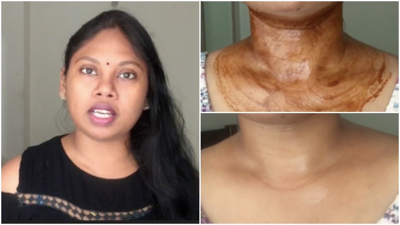 How to Get Rid of Dark Neck in 15 Minutes || DIY DAY 3 || NECK BRIGHTENING AT HOME - YouTube