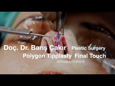 polygon tipplasty final touch in rhinoplasty. Dr. Barış Çakır