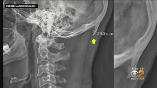 New Study Says ‘Tech-Neck’ Is Causing Bone Spurs At Base Of Skull screenshot 5