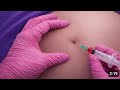 Pain-Free Injection Technique 💉 | Step-by-Step Tutorial