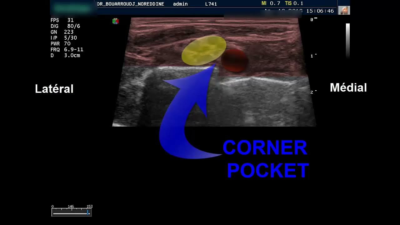 BLOC SUPRACLAVICULAIRE PLEXUS BRACHIAL