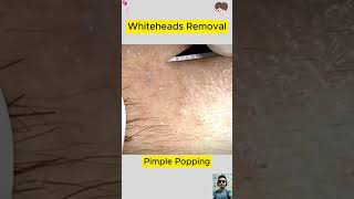 Satisfying Whiteheads Removal Pimple Popping | blackheads whiteheads spa 2
