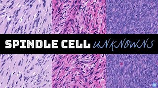 SPINDLE CELL UNKNOWNS | Bone & Soft Tissue Pathology Cases for Residents | #BSTPATH screenshot 4