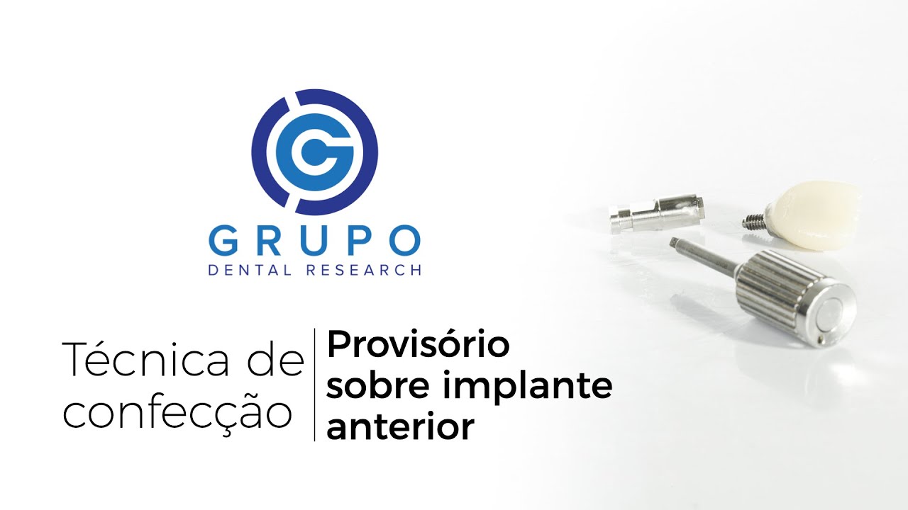 Coroa Provisória Sobre Implante Anterior (Técnica direta): como fazer?