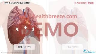 [시연용] c0276aako_대장암 로봇수술 안내