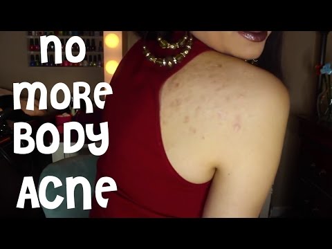 How to Get Rid of Body Acne