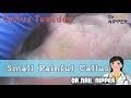 Can you spot this Small Callus?  Small Painful Foot Callus | Callus Tuesday #38