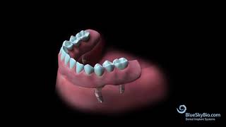 Angled and Straight Overdenture Chairside Technique