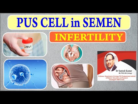Why do Pus Cells appear in Semen? Pus Cells in Semen - Treatment by Dr. (Prof) Santosh Kumar PGI.