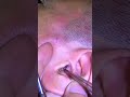 Ear Cleaning #323