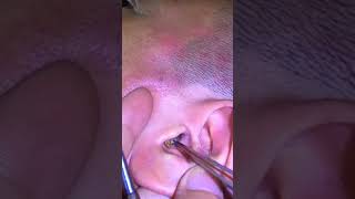 Ear Cleaning #323