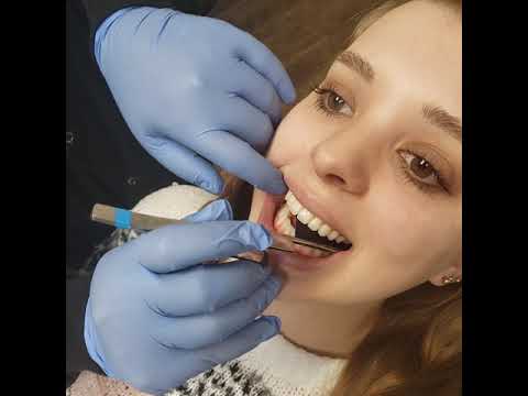 Come prendere Invisalign Foto