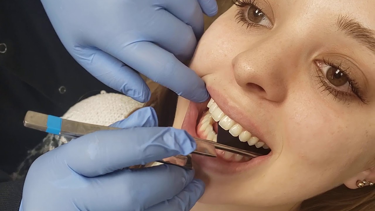 How to take Invisalign Photos
