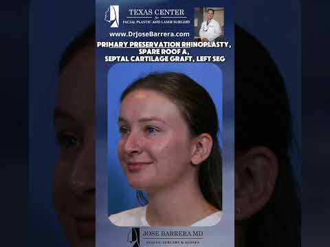 Video thumbnail: 👃✨ Refined, Functional, and Natural – Primary Preservation Rhinoplasty Reveal! · Dr. Jose Barrera