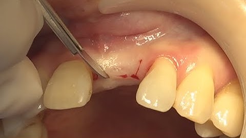 Minimally invasive surgery with Narrow implant