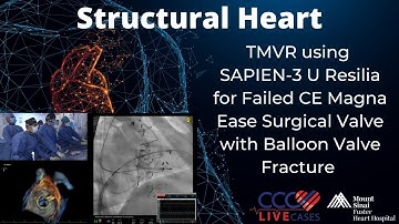 TMVR using SAPIEN-3 U Resilia for Failed CE Magna Ease Surgical Valve with Balloon Valve Fracture