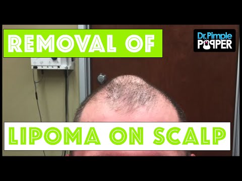 A Self-proclaimed Unicorn Hump: Removal By Dr Pimple Popper