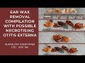 EAR WAX REMOVAL COMPILATION WITH POSSIBLE NECROTISING OTITIS EXTERNA - EP 194