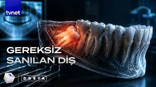 Neden yirmilik dişleri çekmek istiyorlar?