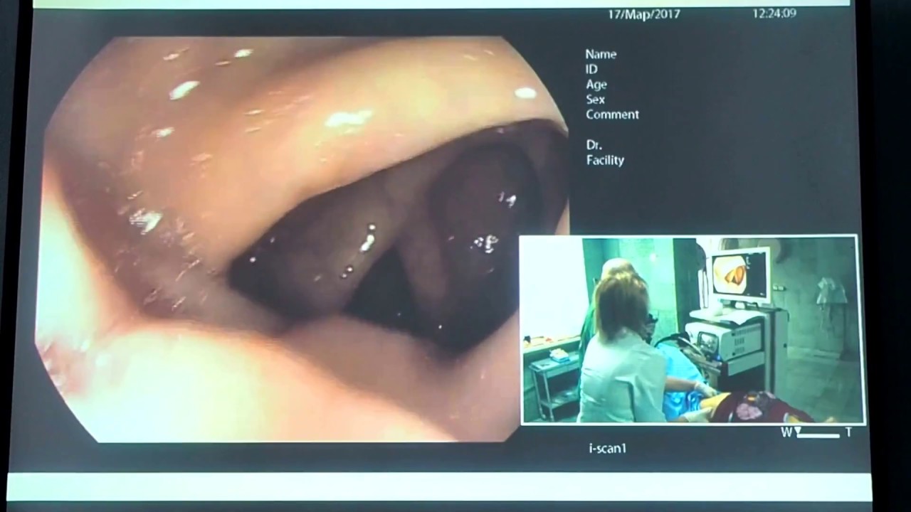 15Live Веселов ВВ Трудная Колоноскопия PENTAX 7010 Фортранс