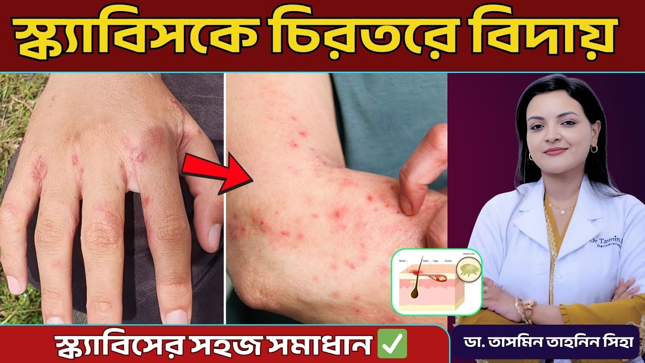 স্ক্যাবিস কেন হয়? খুঁজলি (Scabies) থেকে মুক্তির উপায় | Dr. Tasmin Tahnin Siha | চর্মরোগ বিশেষজ্ঞ