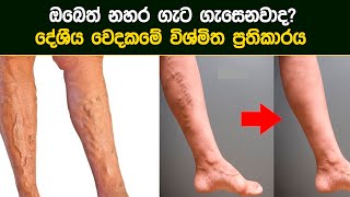 නහර ගැට ගැසීමට ආයුර්වේද ප්‍රතිකාර | nahara gata gasima | Ayurvedic Treatment | 2022.03.08