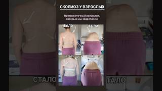 #СКОЛИОЗ у взрослых можно скорректировать визуально и не допустить болей в спине