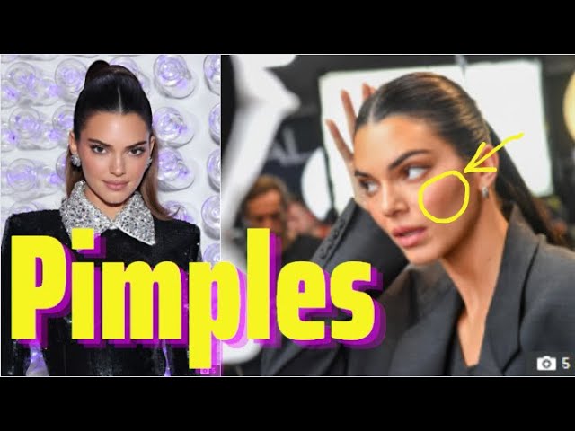 Kendall Jenner shows off her real skin texture including natural blemishes  in rare unedited new pics during LA outing