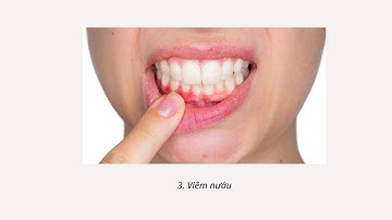 Những Điều Cần Biết Về Bệnh Viêm Nha Chu I Nha Khoa Daisy