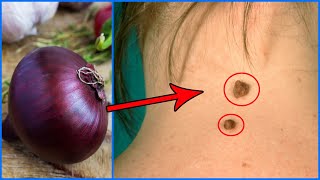 REMOVE SKIN TAGS OVERNIGHT WITH ONION | HOW TO REMOVE SKIN TAG - SKIN TAG REMOVAL