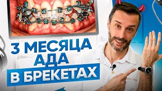 Первые 3 месяца лечения на брекетах - самый сложный период