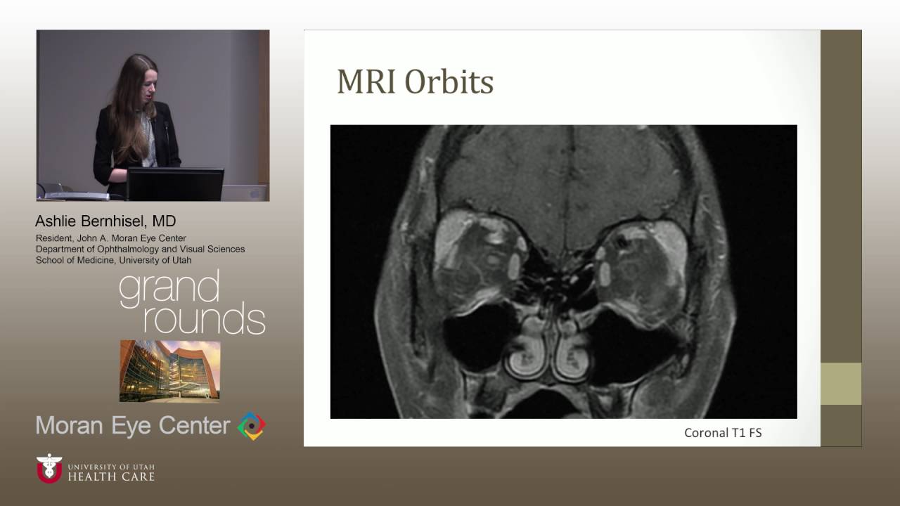 http://clinicaltrials.gov Hemoptysis and Vision Loss in a 13-year-old girl